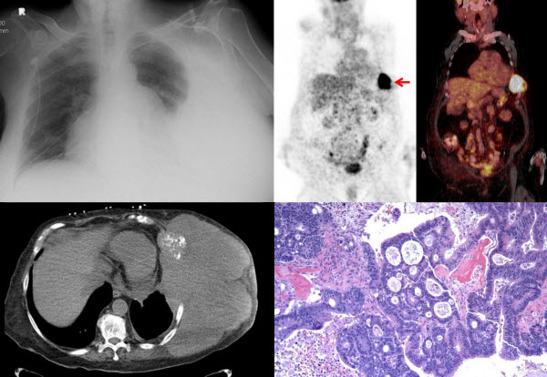 A Case Of Colorectal Cancer With Metastasis To The Chest Wall And