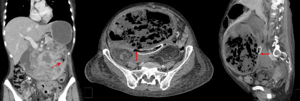 Fistulation As A Complication Of Intra Abdominal Soft Tissue Sarcomas