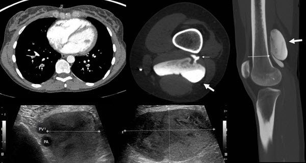 Popliteal Vein Aneurysm Presenting As Recurrent Pulmonary Embolism Lim Journal Of Radiology