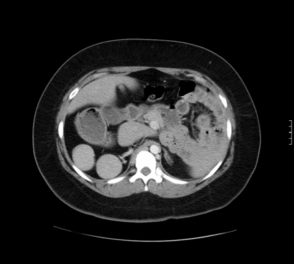 Epiploic Appendagitis In A Female Patient With Situs Ambiguous