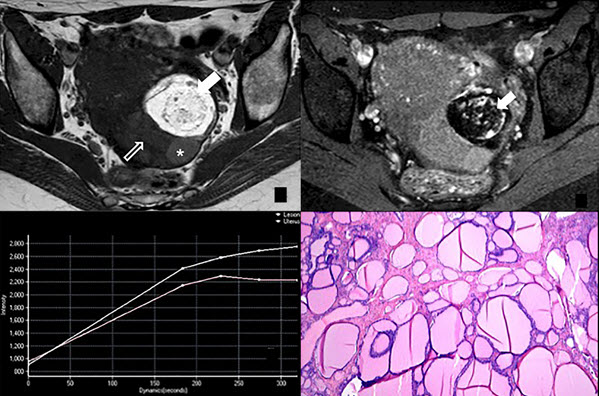 Mature Cystic Teratoma With High Proportion Of Solid Thyroid Tissue A