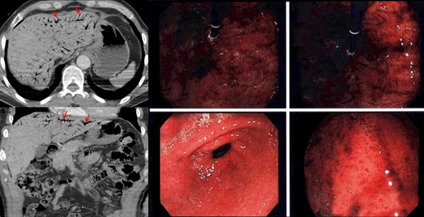 Accidental Concentrated Hydrogen Peroxide Ingestion Associated With Portal Venous Gas Radiology Teaching Point Radiology Education By The Journal Of Radiology Case Reports