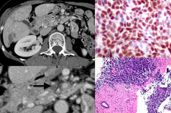 Metastatic Disease