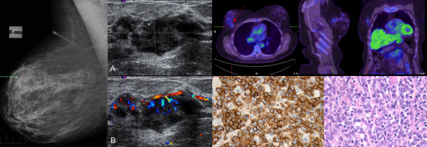 breast lymphoma