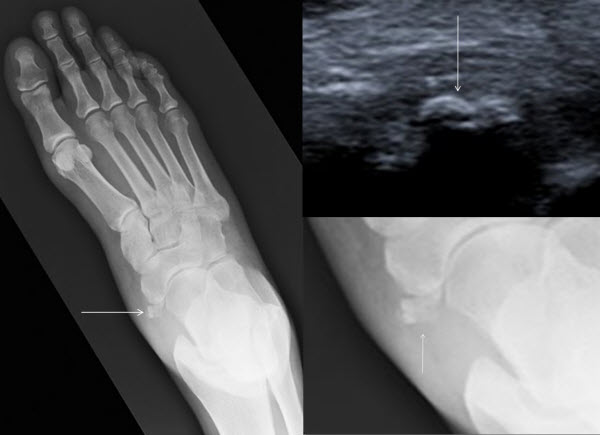 Calcific Tendonitis Of The Tibialis Posterior Tendon At The Navicular