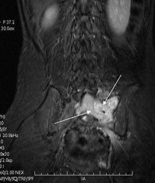 Sarcoma Mri