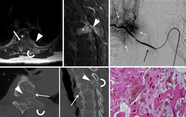 Bone Hemangioma