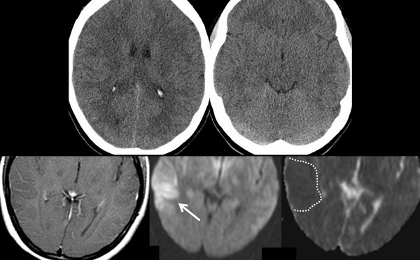 Nmda Encephalitis