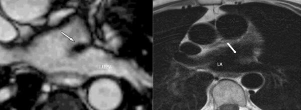 The Coumadin Ridge An Important Example Of A Left Atrial Pseudotumour