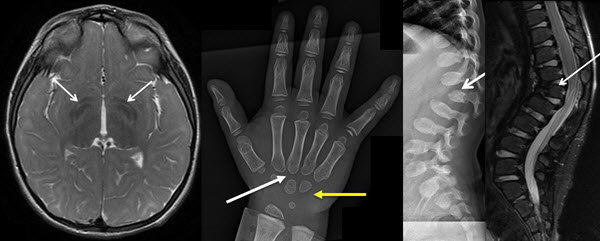 Skeletal And Brain Abnormalities In Fucosidosis, A Rare Lysosomal ...