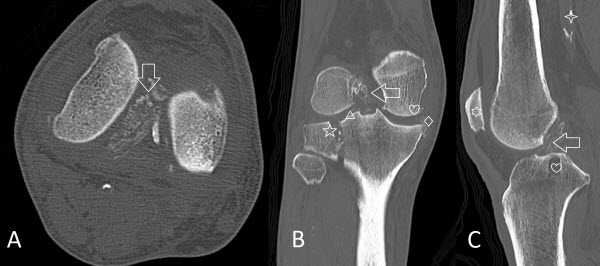 Incidental Anterior Cruciate Ligament Calcification: Case Report ...