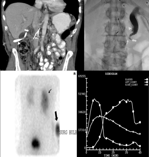 presence of foley catheter icd 10