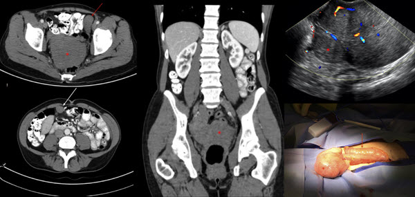 disseminated-peritoneal-leiomyomatosis-status-post-laparoscopic