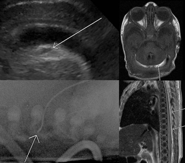 Lipid Infusion Through Malpositioned Central Venous Catheter: Head ...