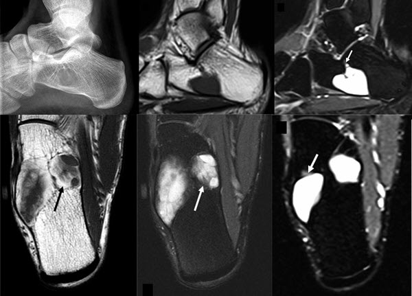 Tibial Intraosseous Ganglion Cyst