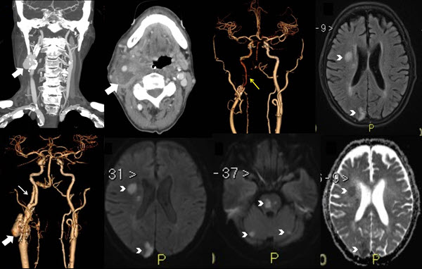 Carotid Mycotic Aneurysm associated with Persistent Primitive ...