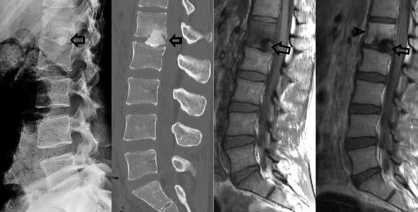 A Rare Cause of Acute Back Pain in a Young Adult: Case Report and ...