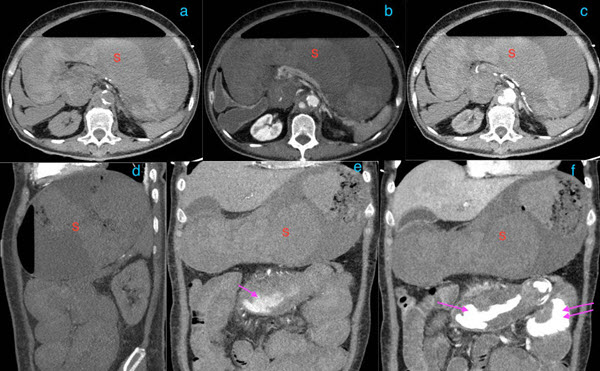 Aortoenteric fistula secondary to an Inflammatory Abdominal Aortic ...