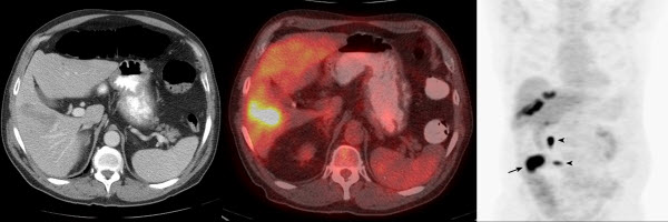 hepatic lymphoma - meddic