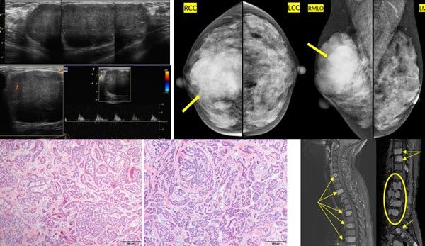 Adenoid Cystic Carcinoma Of The Breast A Study Of Five Cases Liu