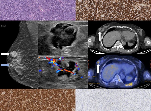 extramedullary-plasmacytoma-of-the-breast-in-a-patient-with-multiple