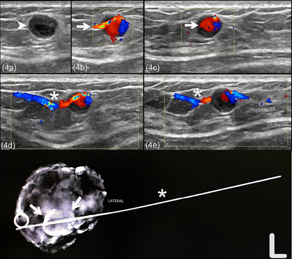 Pseudoaneurysm after an ultrasoundguided breast core needle biopsy in a lactating woman
