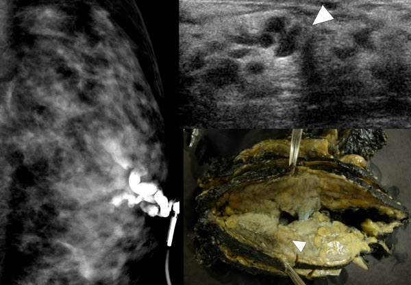 Mammary Duct Ectasia Collection Of Ultrasound Images Kulturaupice