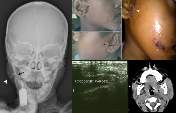 Accessory Parotid Gland With Ectopic Fistulous Duct Diagnosis By Ultrasonography Digital