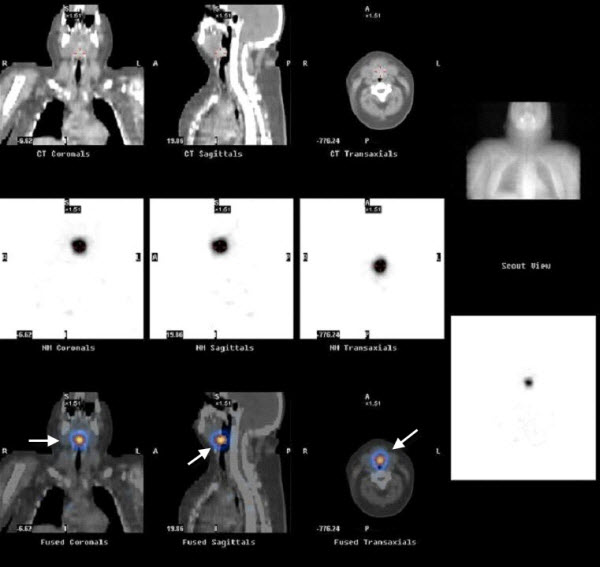 Iodine 131 ablation of an obstructive lingual thyroid