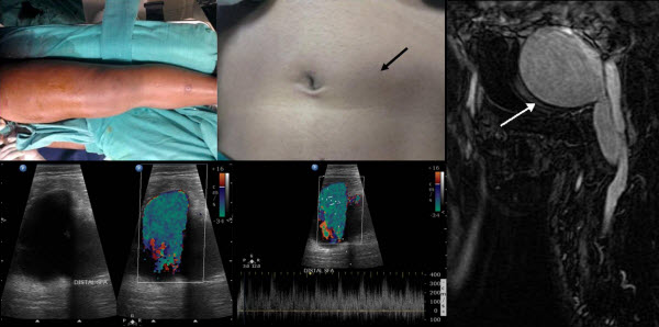 Endovascular Stent Graft for Post-traumatic Superficial Femoral Artery ...