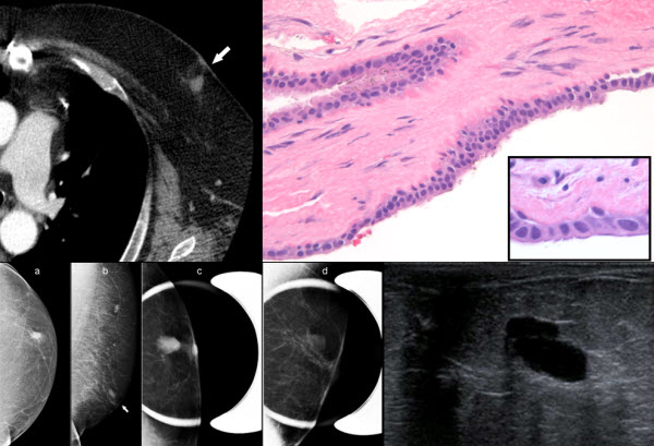 benign-breast-cyst-without-associated-gynecomastia-in-a-male-patient-a