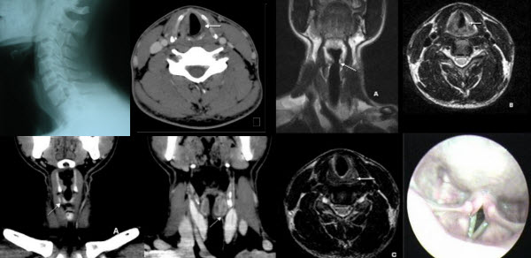 Cadaveric position of unilateral vocal cord: a case of ...