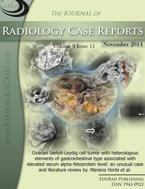 Journal of Radiology Case Reports November 2014 issue - Cover page: Ovarian Sertoli-Leydig cell tumor with heterologous elements of gastrointestinal type associated with elevated serum alpha-fetoprotein level: an unusual case and literature review by Mari