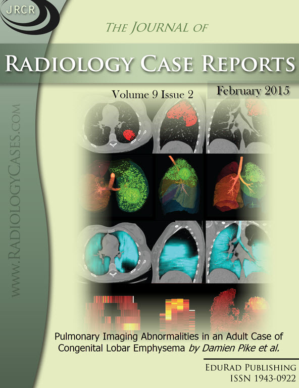 Journal of Radiology Case Reports February 2015 issue - Cover page: Pulmonary Imaging Abnormalities in an Adult Case of Congenital Lobar Emphysema by Damien Pike et al.