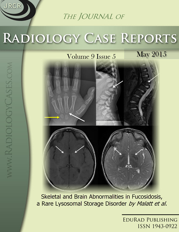 Journal of Radiology Case Reports May 2015 issue - Cover page: Skeletal and Brain Abnormalities in Fucosidosis, a Rare Lysosomal Storage Disorder by Malatt et al.