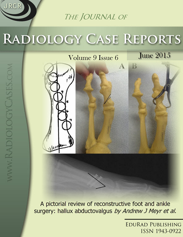 Journal of Radiology Case Reports June 2015 issue - Cover page: A pictorial review of reconstructive foot and ankle surgery: hallux abductovalgus by Andrew J Meyr et al.