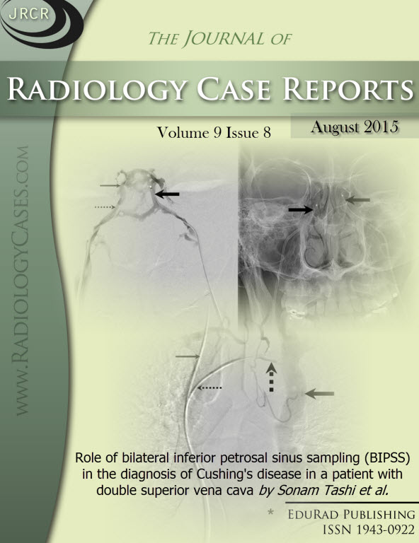 Journal of Radiology Case Reports August 2015 issue - Cover page: Role of bilateral inferior petrosal sinus sampling (BIPSS) in the diagnosis of Cushing's disease in a patient with double superior vena cava by Sonam Tashi et al.