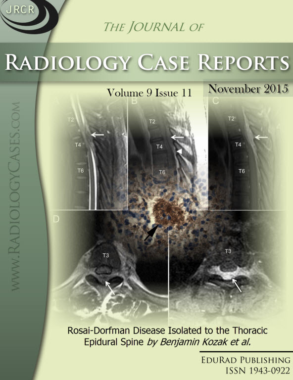 Journal of Radiology Case Reports November 2015 issue - Cover page: Rosai-Dorfman Disease Isolated to the Thoracic Epidural Spine by Benjamin Kozak et al.