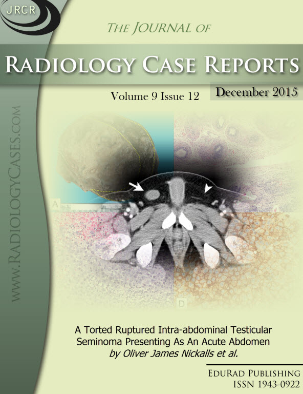 Journal of Radiology Case Reports December 2015 issue - Cover page: A Torted Ruptured Intra-abdominal Testicular Seminoma Presenting As An Acute Abdomen by Oliver James Nickalls et al.