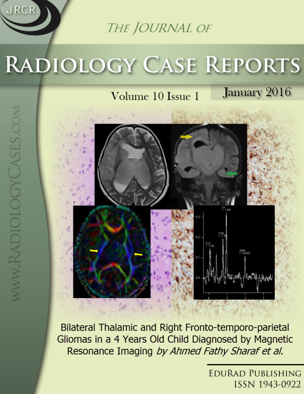 Journal of Radiology Case Reports January 2016 issue - Cover page: Bilateral Thalamic and Right Fronto-temporo-parietal Gliomas in a 4 Years Old Child Diagnosed by Magnetic Resonance Imaging by Ahmed Fathy Sharaf et al.