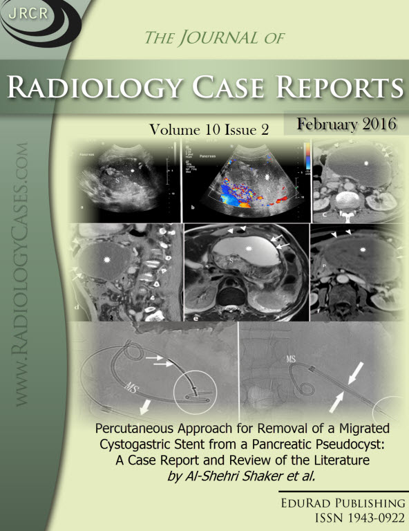 Journal of Radiology Case Reports February 2016 issue - Cover page: Percutaneous Approach for Removal of a Migrated Cystogastric Stent from a Pancreatic Pseudocyst: A Case Report and Review of the Literature by Al-Shehri Shaker et al.
