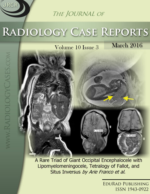 Journal of Radiology Case Reports March 2016 issue - Cover page: A Rare Triad of Giant Occipital Encephalocele with Lipomyelomeningocele, Tetralogy of Fallot, and Situs Inversus by Arie Franco et al.