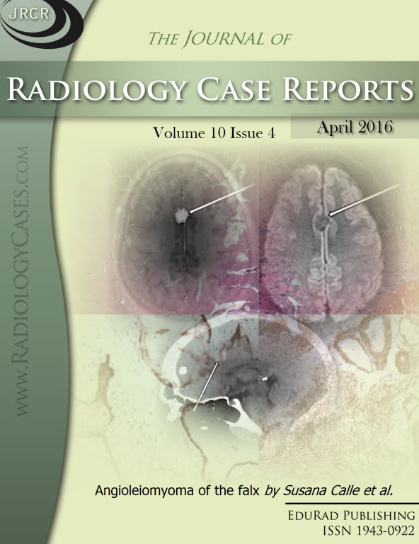 Journal of Radiology Case Reports April 2016 issue - Cover page: Angioleiomyoma of the falx by Susana Calle et al.
