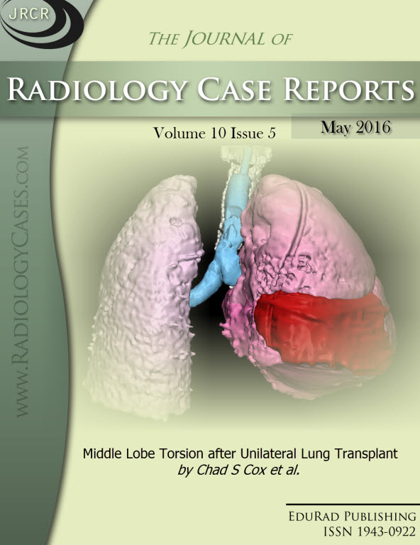 Journal of Radiology Case Reports May 2016 issue - Cover page: Middle Lobe Torsion after Unilateral Lung Transplant by Chad S Cox et al.