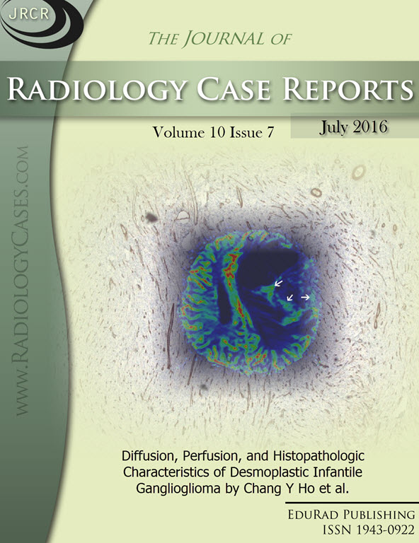 Journal of Radiology Case Reports July 2016 issue - Cover page: Diffusion, Perfusion, and Histopathologic Characteristics of Desmoplastic Infantile Ganglioglioma by Chang Y Ho et al.