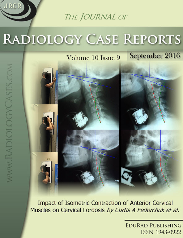 Journal of Radiology Case Reports September 2016 issue - Cover page: Impact of Isometric Contraction of Anterior Cervical Muscles on Cervical Lordosis by Curtis A Fedorchuk et al.