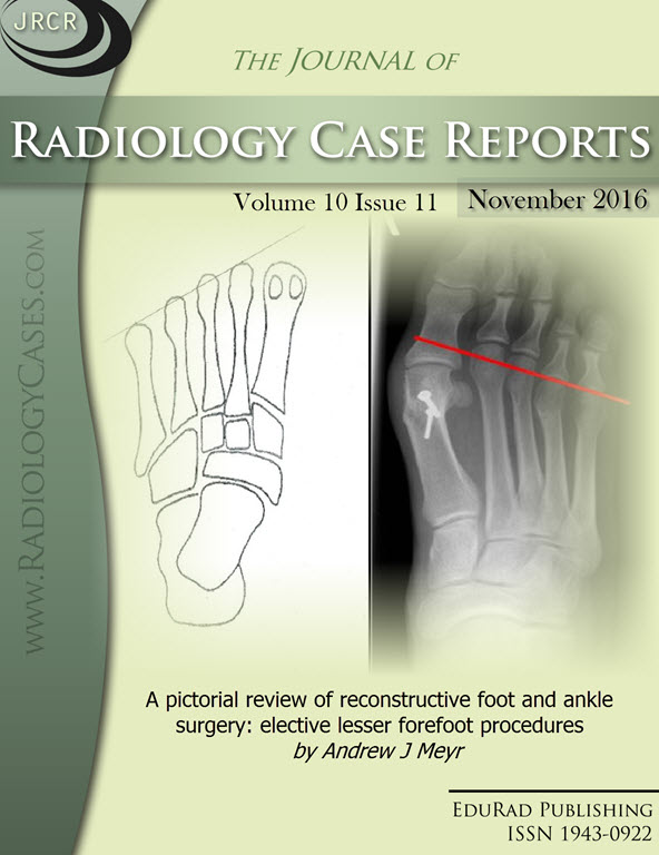 Journal of Radiology Case Reports November 2016 issue - Cover page: A pictorial review of reconstructive foot and ankle surgery: elective lesser forefoot procedures by Andrew J Meyr