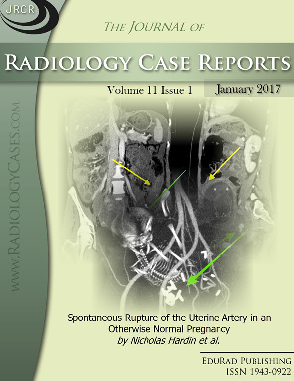 Journal of Radiology Case Reports January 2017 issue - Cover page: Spontaneous Rupture of the Uterine Artery in an Otherwise Normal Pregnancy by Nicholas Hardin et al.