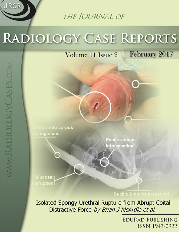 Journal of Radiology Case Reports February 2017 issue - Cover page: Isolated Spongy Urethral Rupture from Abrupt Coital Distractive Force by Brian J McArdle et al.