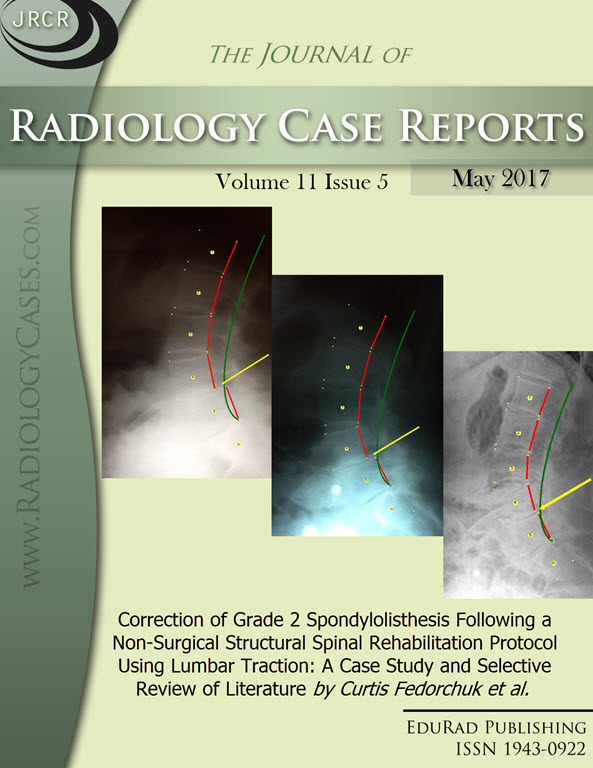 Journal of Radiology Case Reports May 2017 issue: Correction of Grade 2 Spondylolisthesis Following a Non-Surgical Structural Spinal Rehabilitation Protocol Using Lumbar Traction: A Case Study and Selective Review of Literature by Curtis Fedorchuk et al.